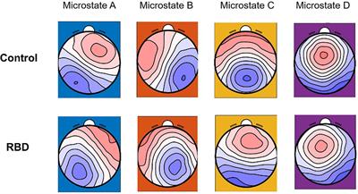 Abnormalities of Resting-State Electroencephalographic Microstate in Rapid Eye Movement Sleep Behavior Disorder